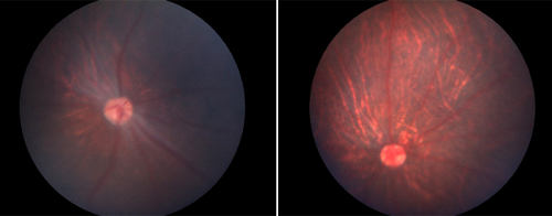 Mutant (left) and treated retinas.